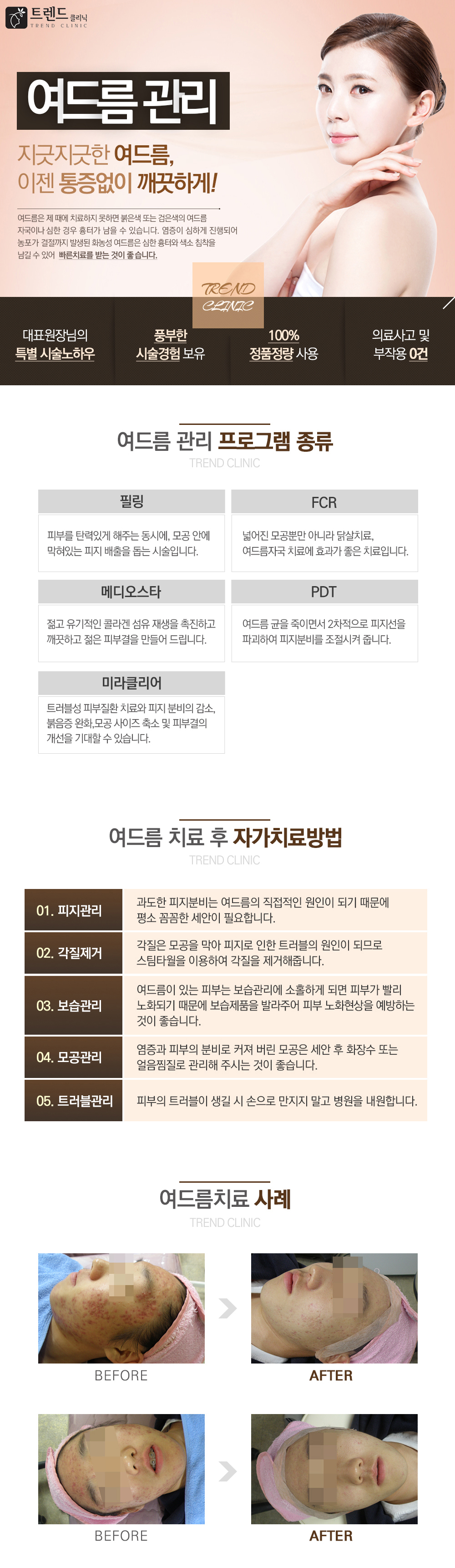 여드름관리 : 지긋지긋한 여드름피부 고민, 통증 없이 깨끗하게! 여드름은 모낭과 피지선의 염증에 의해
얼굴, 가슴, 목 부위에서 발생하는 염증성 피부 병변입니다. 사춘기와 젊은 연령층에 많이 발생하는 것으로 알려져 있지만 근래에서 25세 이상의
성인형 여드름이 많아지고 있습니다. 중년까지 지속적으로 발생하기도 합니다.
여드름은 제때에 치료하지 못하면 붉은색 또는 검은색의 여드름 자국이나 심한 경우 흉터가 남을 수 있습니다. 염증이 심하게 진행되어 (화농), 농포가 결절까지 발생된
회농성 여드름은 심한 흉터와 색소 침착을 남길 수 있습니다. 
아이솔레이즈 : 
01 흉터 없는 맞춤 여드름 치료
02 통증 없이 여드름을 짜면서 제거
03 여드름 원인균 제거로 재발률 다운
04 여드름 자국 개선과 탄력까지
메디오스타
01 여드름, 주름, 미백의 3가지 효과를 동시에
02 한번 시술로도 오랜기간 효과 지속
03 최상의 롤링시스템으로 통증이 거의 없음 
04 일상생활에 지장이 없는 간편함
여드름을 악화시키는 원인
- 수면부족
- 자율신경의 부조화로 인한 위장 장애
- 피부 영양공급 부족
- 여성의 경우 생리 전 호르몬의 변화로 인해 일주일 사이 여드름이 나빠질 수 있다.
- 피부에 맞지 않는 화장품, 자외선 차단제 등
- 마차과 같은 기계적인 자극
- 스트레스 
여드름 치료 후 자가치료방법
01 피지관리
과도한 피지분비는 여드름의 
직접적인 원인이
되기 때문에 평소 꼼꼼한 
세안이 필요합니다.
02 각질제거
각질은 모공을 막아 피지로 인한
트러블의 원인 되므로 스팀타월을
이용하여 각질을 게저해줍니다.
그러나 여드름이 심할 경우 자극을 줄 수있는
각질제거 제품 사용은 자제하는 것이 좋습니다.
03 보습관리
여드름이 있는 피부는 보습관리에
소홀하게 되면 피부가 빨리 노화되기 때문에
눈가, 입, 등 특히 건성 피부의 경우 
보습제품을 발라주어 피부 노화현상을 
예방하는 것이 좋습니다.
04 모공관리
염증과 피부의 분비로 커져 버린 모공은
세안 후 화장수 또는 얼음찜질로
관리해 주시는것이 좋습니다. 
05 트러블 관리
피부의 트러블의 생길 시 손으로
만지지 말고 병원을 내원합니다.
