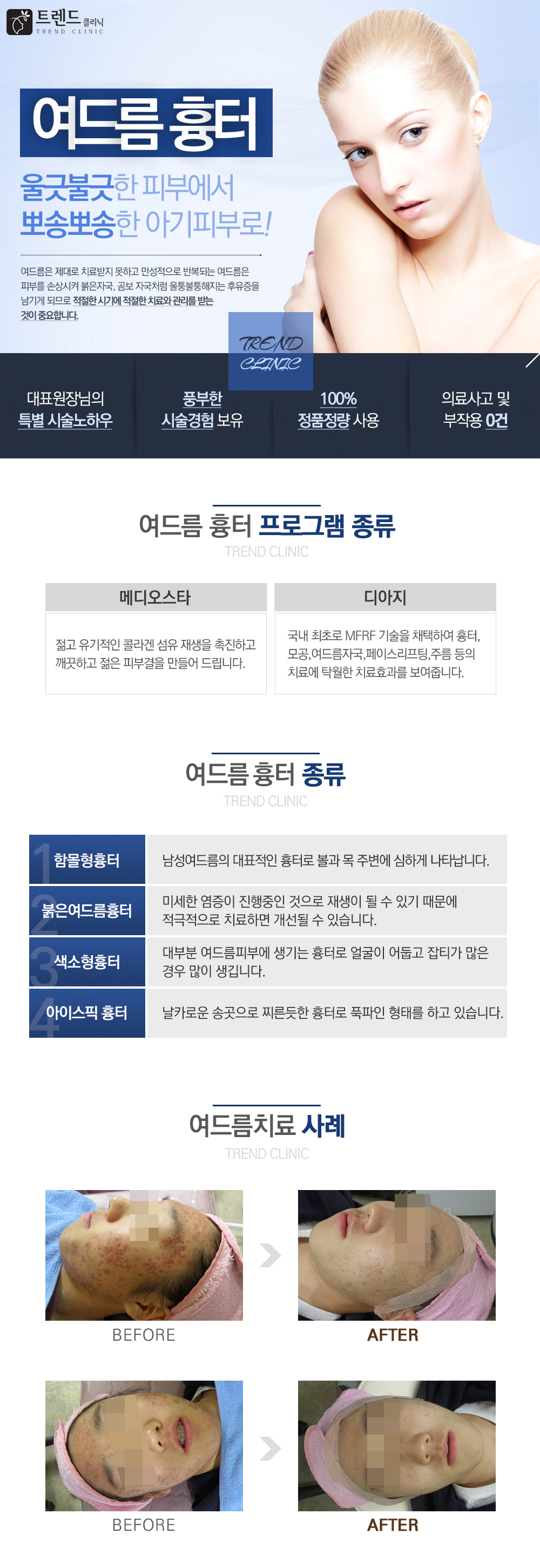 여드름흉터 : 울퉁불퉁 마음까지 심난한 흉터, 매끈한 달걀 피부로! / 과다하게 분비된 피지가 모공에서 원활하게 배출되지 못한 상태에서 세균에 감염되어 나타나는 염증성 질환입니다. 제대로 치료받지 못하고 만성적으로 반복되는 여드름은 피부를 손상시켜 붉은자국, 갈색자국, 곰보 자국처럼 울퉁불퉁해지는 등의 반영구적, 영구적 후유증을 남기게 됩니다. 따라서 적절한 시기에 적절한 치료와 관리를 받는 것이 중요합니다. / 과다하게 분비된 피지가 모공에서 원활하게 배출되지 못한 상태에서 세균에 감염되어 나타나는 염증성 질환입니다. 제대로 치료받지 못하고 만성적으로 반복되는 여드름은 피부를 손상시켜 붉은자국, 갈색자국, 곰보 자국처럼 울퉁불퉁해지는 등의 반영구적, 영구적 후유증을 남기게 됩니다. 따라서 적절한 시기에 적절한 치료와 관리를 받는 것이 중요합니다. 

뷰레인 : 
01 주변 조직의 열손상이 적은 안전한 시술
02 부작용이 걱정이 거의 없는 시술 
03 시술 후 피부재생 회복이 빠름
04 점 제거 후 흉터가 적어 시술 후 화장과 세안이 가능

플라톤레이저

01 화상, 색소침착이 거의 없는 안전한 시술 
02 튼살, 흉터, 탄력까지 동시에 개선 가능
03 시술 후 피부재생 회복이 빠름
04 점 제거 후 흉터가 적어 시술 후 화장과 세안이 가능

MTS
01 깊은 흉터 완하에 효과적
02 약물이 깊숙이피부에 치투하여 치료 효과증대  
03 피부톤 및 닭살 개선에 효과적
04 탄력, 리프팅 개선에도 효과적

여드름 흉터 종류 : 
- 함몰형흉터
남성여드름의 대표적인 흉터로 
볼과 목 주변에 심하게 나타 납니다.

- 붉은여드름흉터
미세한 염증이 진행중인것으로 재생이 될수 있기 
때문에 적극적으로 치료 하면 개선될수 있습니다. 

- 색소형흉터
대부분 여드름피부에 생기는 흉터로 
얼굴이 어둡고 잡티가 많은경우 많이 생깁니다.

- 아이스픽 흉터 
날카로운 송곳으로 찌른듯한 흉터로 
푹파인 형태를 하고 있습니다. 

여드름 치료
약물요법
여드름 균을 죽이고 피지분비를 조절합니다. 약물 처방시 전문의의 상담과 교육이 필요합니다.

PDT
Photodynamic therapy의 약자로 여드름 균을 죽이면서 2차적으로 피지선을 파괴하여 피지분비를 조절시켜 줍니다.

Alieen long pulse Nd-Yag레이저 치료
여드름 치료의 최신기법으로 일상생활에 큰 불편감 없이 
여드름 균을 죽이고 더불어 붉음증을 감소시키고 검은 색소침착도 덜일어나게 하는 레이저 치료법입니다

메디컬스킨케어
스페셜 에스테티션의 차별화된 여드름 케어 치료를 경험하실수 있습니다.

여드름 흉터 치료
여드름 흉터의 기본개념은 첫번째 피부를 깍아주고 
두 번째는 피부를 채워주는 시술을 병행하는 것입니다. 
피부안을 채워만주는 시술법은 효과에 한계가 있고 환자의 만족도도 떨어지게 됩니다. 
피부를 깍아주는 시술법은 상대적으로 다운타임이 늘어나게 되나 
셀레스 클리닉은 명품 장비와 다수의 시술경험으로 이를 보완하였습니다.

- 서브시전
강한 섬유성 밴드에 묶인 흉터를 직접 끊어줍니다
- DOT필링
깊거나 뾰족한 흉터의 경우 TCA약물치료를 통해 피부를 재생 시킵니다
- 프락셔널 MCL 30
독일에서 제작된 장비로 강력하고 미세하게 나눠진 레이저빔이 주위 피부의 손상은 최소로하면서 피부를 정교하게 깍아냅니다. 
흉터,모공치료의 기본입니다.
- 프락셔널 Vivace
최신 프락셔널 고주파 장비로 통증없이 피부내 콜라겐의 활성과 신생을 일으킵니다.
- MTS
가는 침에 의해 자극된 흉터는 재생되게 됩니다.
- PRP
사람의 혈액을 원심분리시켜 피부재생에 관련된 부분만을 채취하여 피부에 도포합니다.
- 줄기세포
피부를 재생시키는 약물을 피부에 투입합니다
- 메디컬 스킨케어
스페셜 에스테티션의 차별화된 여드름 흉터 케어 치료를 경험하실수 있습니다.
